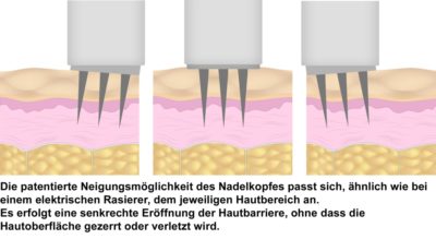 Micro-Needling Schema